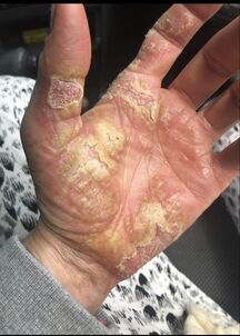 Palmoplantar Pustlosis hand
