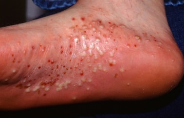 A foot covered in a PPP outbreak