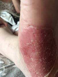 pictures of palmoplantar pustulosis