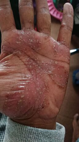 pictures of palmoplantar pustulosis (PPP)