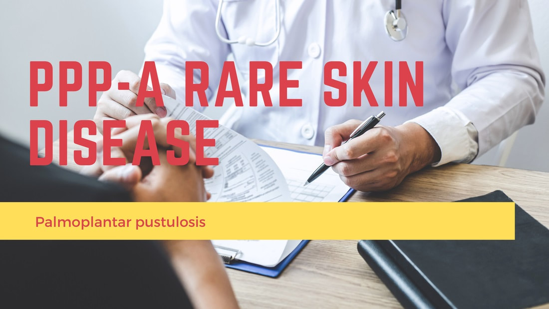 Paloplantar pustulosis-a rare skin disease